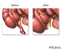 Appendectomy - series