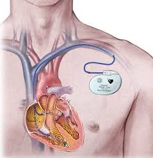 artificial pacemaker