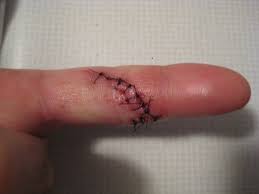 finger cut