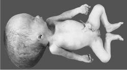 congenital hydrocephalus