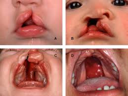 cleft lip palate