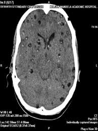 brain cyst