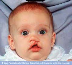 cleft lip palate