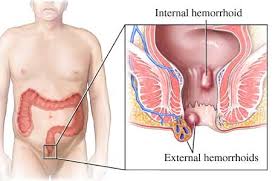 hemorroid treatment
