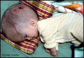 congenital hydrocephalus