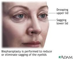 eyelid droop