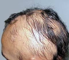 alopecia picture