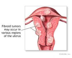 menstrual clots