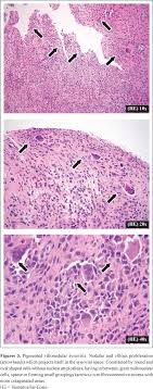 villonodular synovitis and symptoms