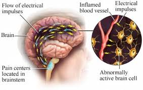 migraine symptoms