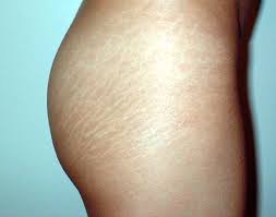 stretchmarks