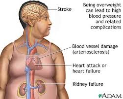 effects of obesity