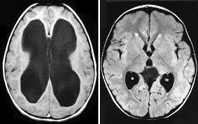 congenital hydrocephalus