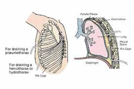 chest drain