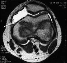villonodular synovitis and symptoms