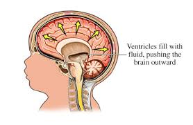 congenital hydrocephalus