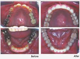 pictures tooth crown
