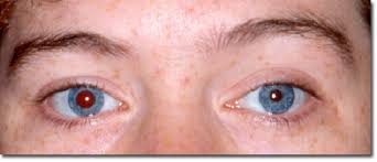 physiologic anisocoria