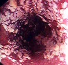 leaky gut syndrome