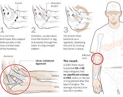 Tommy John surgery often,