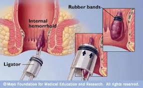 hemorroid treatment