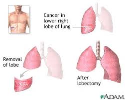 chest drain