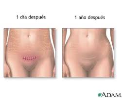 incisiones quirurgicas