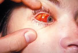 viral infections