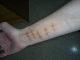 cutting yourself