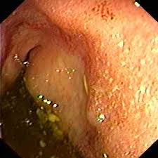anorectal bleeding