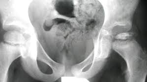perthes disease