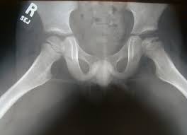 perthes disease