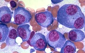 Blood cancer