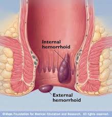 hemorroid treatment