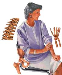 osteoporosis