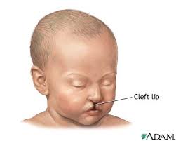 cleft lip palate