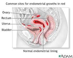 What is Endometriosis?