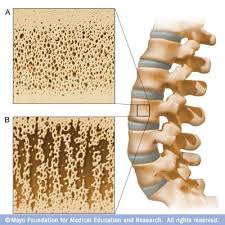 osteoporosis