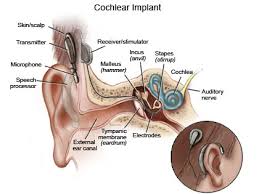 the cochlear implant uses