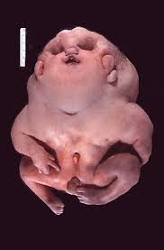 congenital hydrocephalus