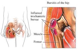bursitis hip