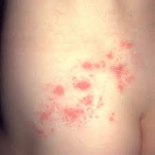 shingles virus