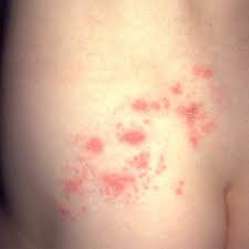 shingles virus