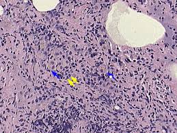 Non-Hodgkins Lymphoma of Lung