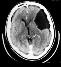 brain cyst