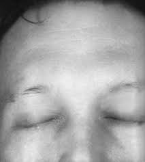 alopecia eyebrow