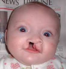 cleft lip palate