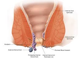 hemorroid treatment