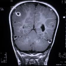 brain cyst