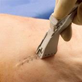 skin staplers